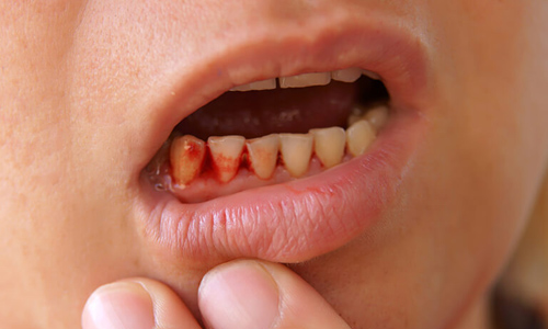 Bleeding Gum Treatment