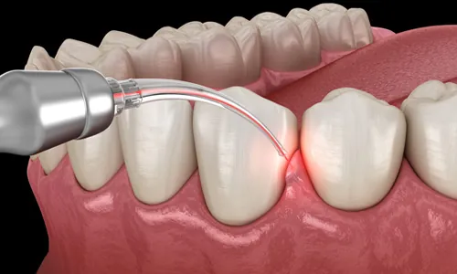Laser Gum Treatment