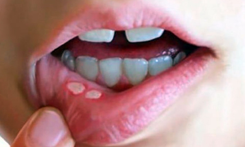 Oral Cancer Screening