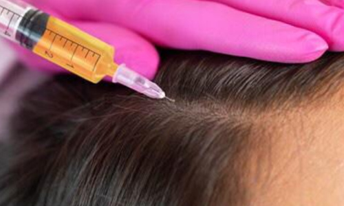 Hair Treatment (PRP)