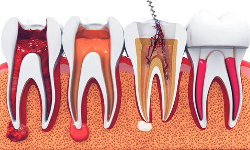 Root Canal Treatment